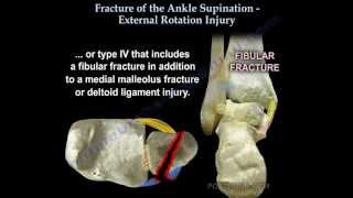 Ankle fracture  Supination External Rotation  Everything You Need To Know  Dr Nabil Ebraheim [upl. by Yetnom]