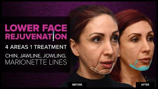 Lower Face Rejuvenation Chin Jawline amp Jowls With Dermal Fillers at Mabrie Facial Institute [upl. by Ahseim]