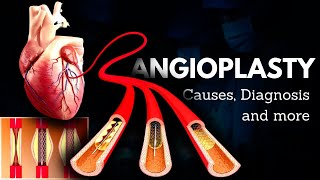 Angioplasty Causes Signs and Symptoms Diagnosis and Treatment [upl. by Flore]