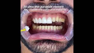 Porcelain veneers This is how we do it [upl. by Dukie]