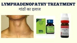 LYMPHADENOPATHY TREATMENTगांठों का ईलाज [upl. by Jsandye]