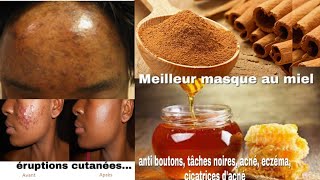 Masque au miel et cannelle contre lacné boutons eczéma cicatrice pores dilatés tâches [upl. by Alvord]