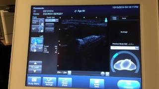 Carotid Ultrasound  Artery Wall Thickness Test and RealTime Arterial Plaque Imaging [upl. by Jangro]