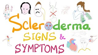 Scleroderma Pathogenesis and Clinical Manifestations Detailed Explanation [upl. by Adnelg]