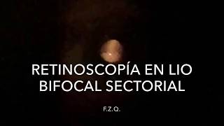 Retinoscopía con LIO bifocal sectorial [upl. by Preuss]