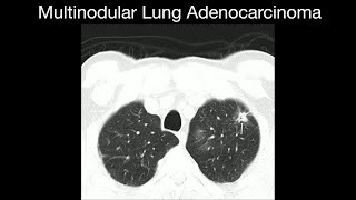 Multinodular Lung Adenocarcinoma [upl. by Valina]