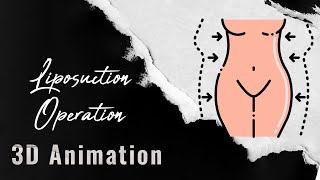 Liposuction Surgery How It Works and What to Expect  3D Animation Overview [upl. by Losse]