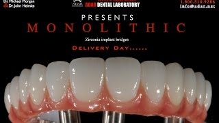 All on 4 Zirconia hybrid Implant Bridge Delivery Day infoadarnet [upl. by Adriena]