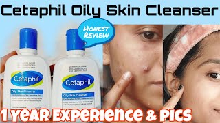 I Tried Cetaphil Oily Skin Cleanser For 1 Year😱Before amp After pics Best Cleanser for Oily Skin [upl. by Ayna976]