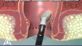 Infrared Coagulation Therapy for Hemorrhoids  3D Medical Animation [upl. by Eatnoid]