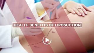 Health Benefits of Liposuction  Houston Plastic Surgery [upl. by Allyce]