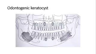 Odontogenic Cysts [upl. by Nofets]