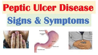 Peptic Ulcer Disease Signs amp Symptoms  Gastric vs Duodenal Ulcers [upl. by Gingras]