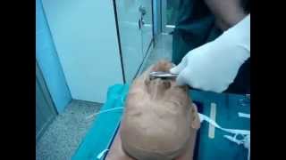 ENT  Posterior nasal packing  การห้ามเลือดวิธี Posterior nasal packing [upl. by Veal]