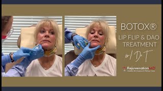 Lip Flip amp DAO Treatment with Botox® [upl. by Nollie]