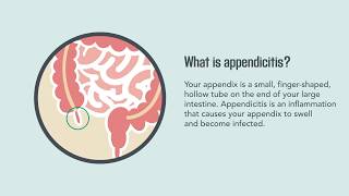 Appendicitis Symptoms Causes Diagnosis and Treatment  Merck Manual Consumer Version [upl. by Omari]