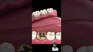 Caries Removing and Crown dentalcrowns toothcrown [upl. by Trebron]