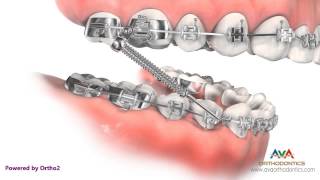 Orthodontic Treatment for Overjet Overbite  Forsus Appliance [upl. by Derreg]