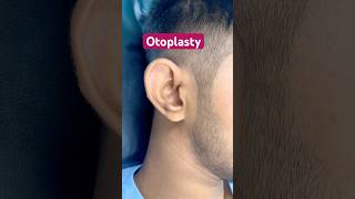 Otoplasty  Ear pinning  doctor laserclinic earshaping earpining beauty skincare fatloss [upl. by Kamila]