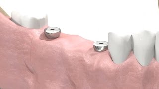 SIC invent Dental Implant  Prosthetic Animation BridgeWork Open Tray Technique [upl. by Zurc]