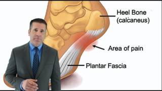 Heel Pain Bone Spurs Plantar Fasciitis Surgery Artesia Rancho Cucamonga Reseda Riverside Norco CA [upl. by Gennie]