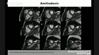 RMN CARDIACA Dr Alejandro Deviggiano [upl. by Nylanaj]