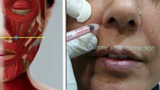 Gummy Smile Correction with Botulinum Toxin [upl. by Easton]