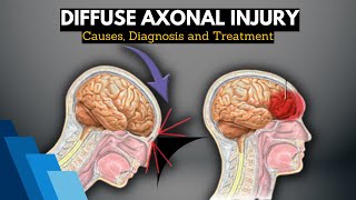 Diffuse Axonal Injury Causes Signs and Symptoms Diagnosis and Treatment [upl. by Nhepets]