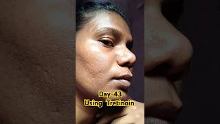 Day43 Using Tretinoin viralvideo tretinoin skincare shorts youtubeshorts [upl. by Nomihs]