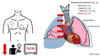 Thoracic Trauma [upl. by Paley]