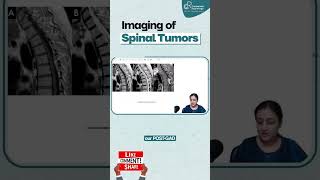 Imaging of Spinal Tumors By Dr Zainab Vora  Radiology Residency  Conceptual Radiology [upl. by Richlad]