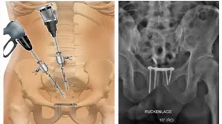 Endoscopic Pelvic Fracture Surgery Koroush Kabir MD [upl. by Peterus]