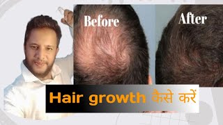 Minoxidil hair regrowth solution resultshow to Use minoxidilबालो के growth कैसा होगा [upl. by Rolan]