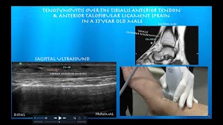 Ultrasound of Tibialis Anterior Tenosynovitis with Anterior TaloFibular Ligament Sprain [upl. by Neelram305]