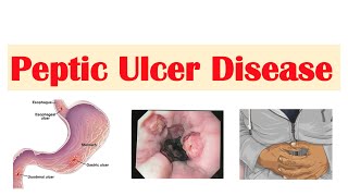 Peptic Ulcer Disease Gastric vs Duodenal Ulcers  Causes Symptoms Diagnosis Treatment [upl. by Any]