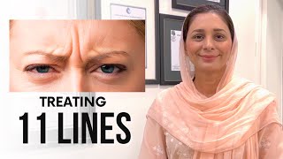 Treating 11 LinesFrown Lines [upl. by Shannan]