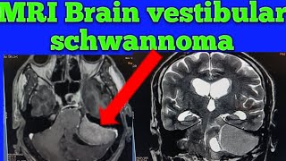 Mri Brain vestibular schwannoma case Mri Brain Acoustic Neuroma Mri Brain CP angle Tumor Tumor [upl. by Anelrats986]