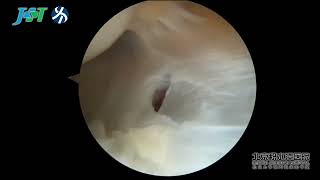 Arthroscopic Repair of Extensor Carpi Radialis Brevis in Patients With Tennis Elbow [upl. by Enailil586]