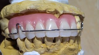 Pustiso with Retainer or Denture with Retainer by DatuAmbasTv [upl. by Lesser]