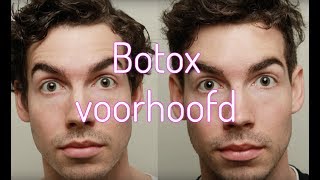 Botox voorhoofd  Furrownl [upl. by O'Rourke]