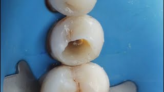 Demonstration of PreEndodontic Build up [upl. by Emelina]