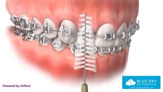 Oral Hygiene with Braces [upl. by Ulyram]