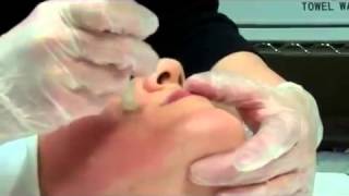 Dermapen Micro Needling Treatment [upl. by Kcinimod194]