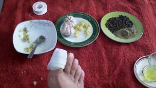 CHAMPIGNON DES ONGLES TRAITEMENT NATUREL معالجة فطر أظافر القدمين [upl. by Idihc]