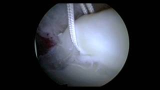 Hip Arthroscopy Labral Repair Surgery  Repair Torn Hip Labrum  Dr David J King [upl. by Rebecka]