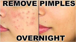 How To Remove Pimples Overnight  Acne Treatment  ShrutiArjunAnand [upl. by Rednal]