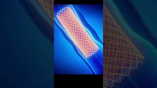 3D Animation of Angioplasty Heart Procedure Medical Animation Explained [upl. by Azilanna337]