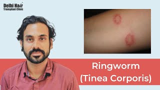 Ringworm Tinea Corporis  Causes Risk Factors Signs amp Symptoms Diagnosis and Treatment  DHTC [upl. by Kiernan]