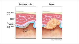 Carcinoma in situ [upl. by Nonnaehr]