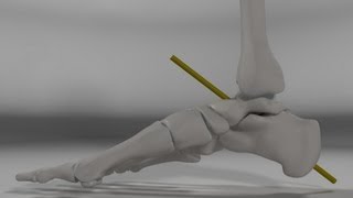 Over Pronation amp Supination Motion Biomechanics of the Subtalar Joint Explained [upl. by Dedie]